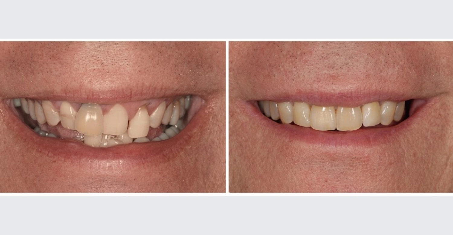 Dental Implants Before and After inblog